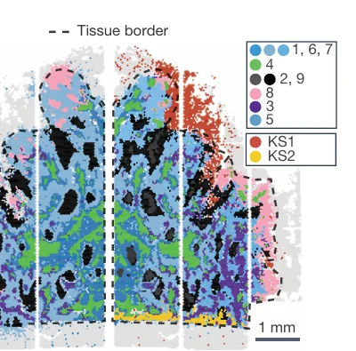 Spatial map of a head and neck tumour section, with a dashed line marking the tissue border. Numbered clusters in blue, green, black, pink and purple fill the tissue interior. Two extra clusters are called out separately in the legend: KS1 in red at the upper right, sitting outside the dashed tissue border, and KS2 in yellow running along the lower edge of the section.