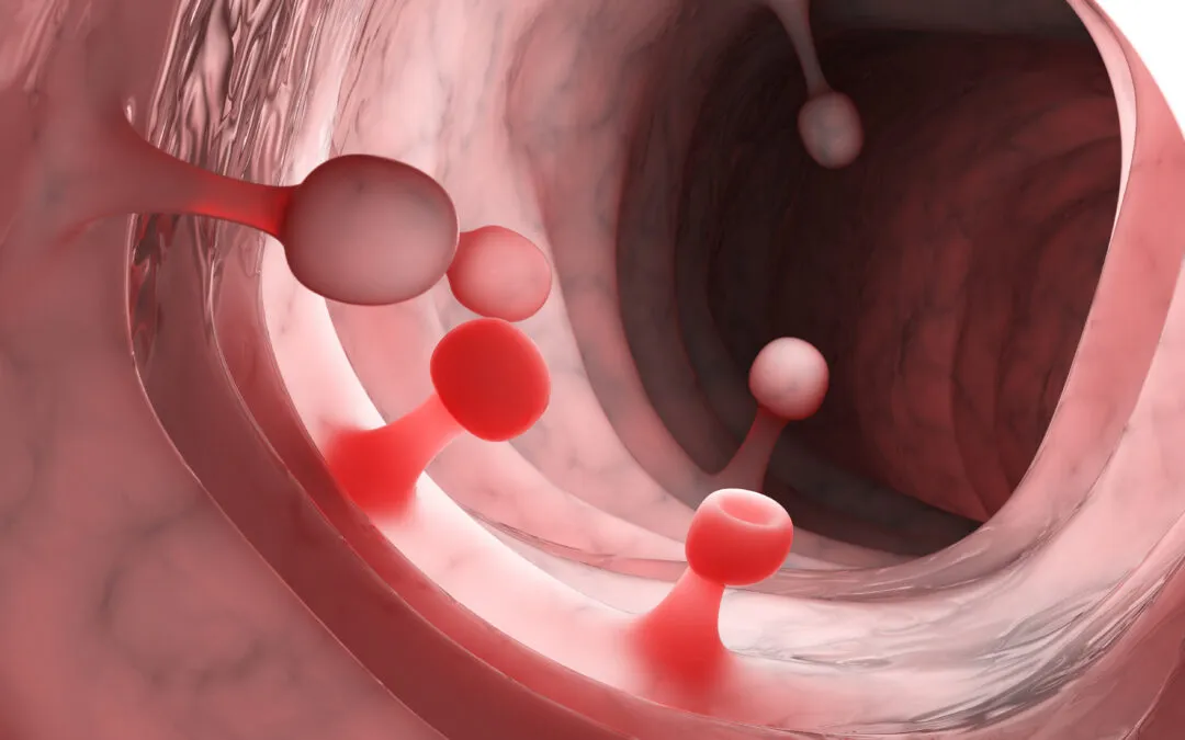 Microscopic view of colon polyps